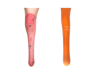 ANKLE DISARTICULATION